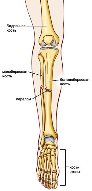 сломанная нога